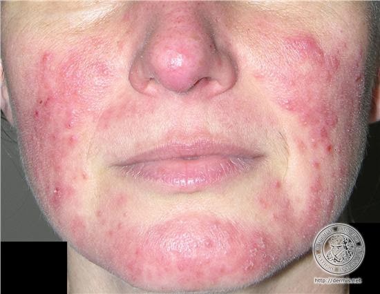Atopichesky la dermatitis sobre las palmas como curar