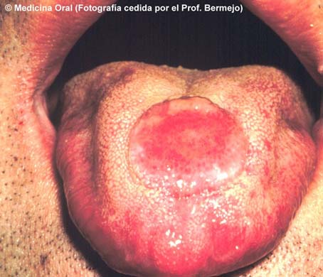 lengua diques lengua diques