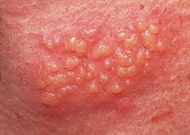 herpes-cure-blogspot