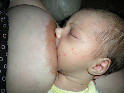 DDD-cup-Implants http://ionlycareaboutyouandme.blogspot.com/2013_02_01_archive.html