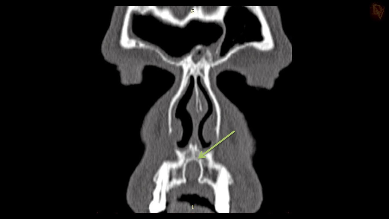 Ultimate Radiology Incisive Canal Cyst (Nasopalatine Duct Cyst)