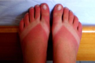 sunburnt+feet.jpg