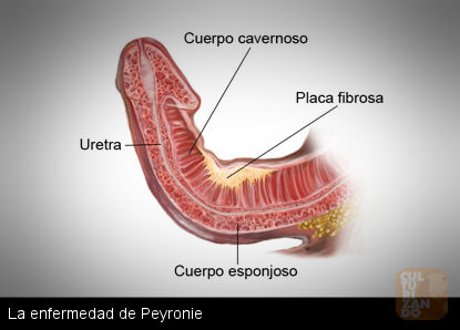 Enfermedad De Peyronie