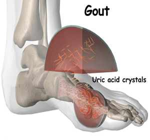 GOUT DISEASE gout disease: