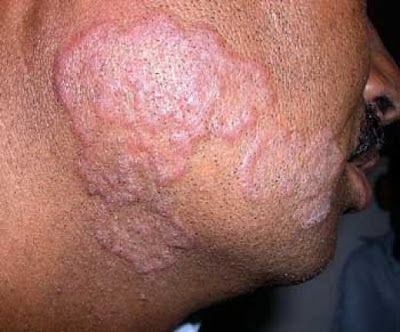 How To Treat Folliculitis In Dogs How To Treat Folliculitis In Dogs