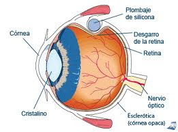 desprendimiento de retina
