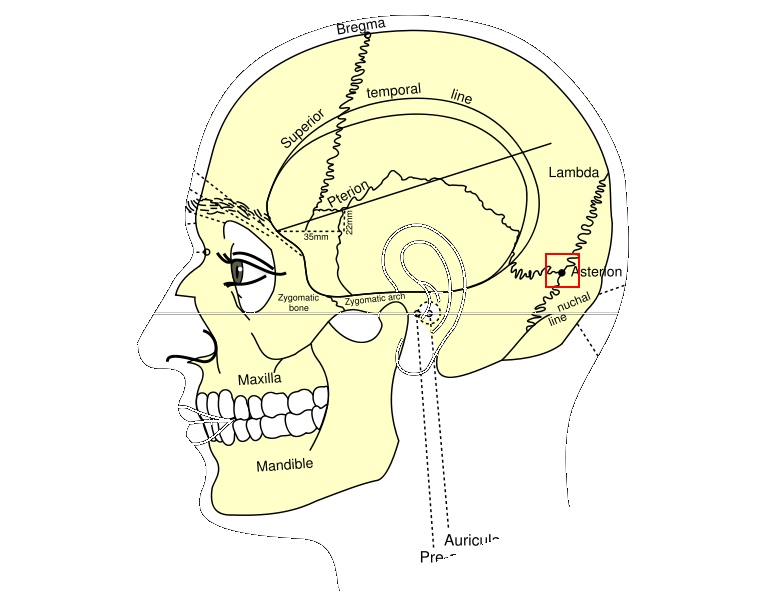 Brain & Mind A to Z Cerebellopontine angle and Retromastoid Craniectomy