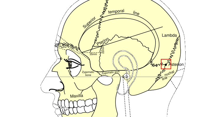 Brain & Mind - A to Z: Cerebellopontine angle and Retromastoid Craniectomy