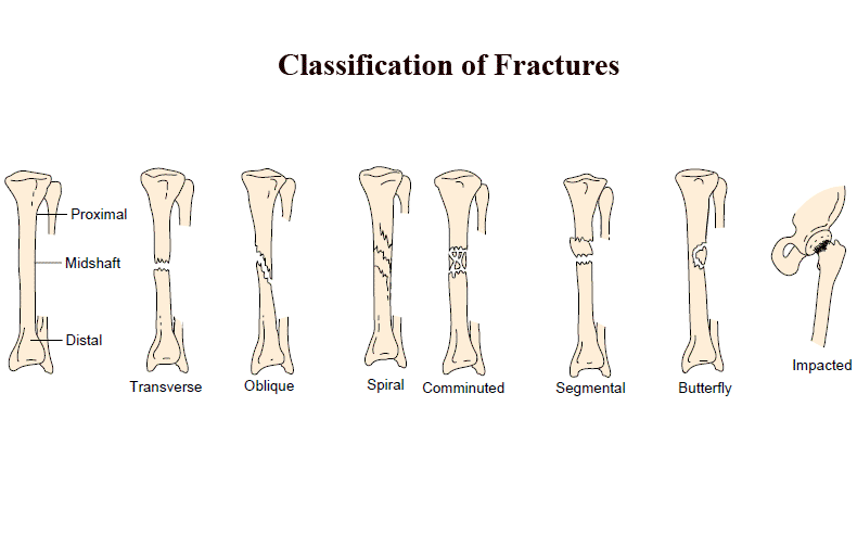 Classification of Bone Fractures