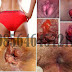 Cara Mengobati Berak atau BAB Keluar Darah Segar thumbnail