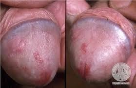 gambar sipilis cara mengobati sipilis, obat herbal sipilis, sipilis latem, gatal dekemaluan