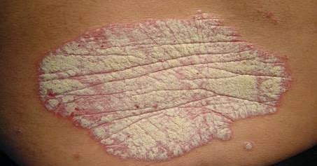 El aceite de maíz para el tratamiento de la eccema
