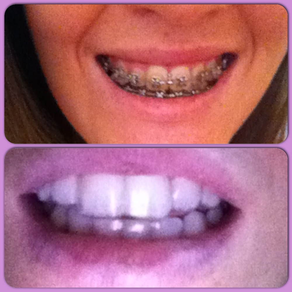 A Guide to Surviving Orthognathic Surgery Cleaning your Braces