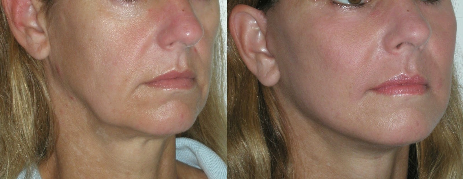 Great Yoga Facial Exercises To Prevent And Reverse Aging Outline And