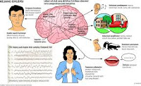 Solusi Alami Mengobati Epilepsi