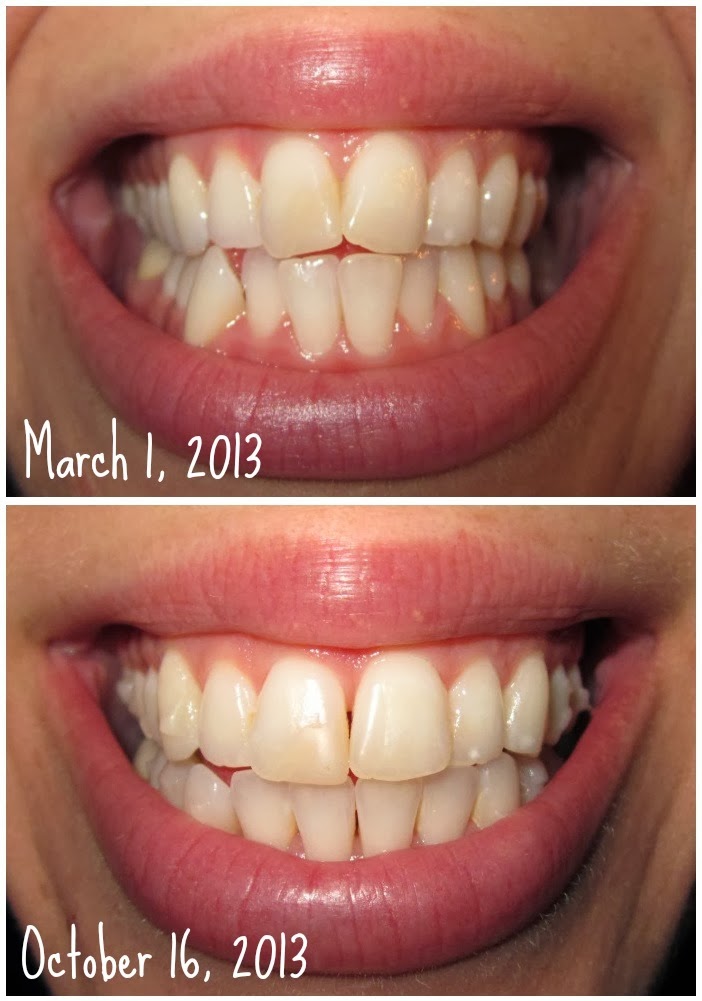 Sunshine! Invisalign Update