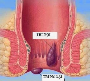 THUỐC CHỮA BỆNH TRĨ HIỆU QUẢ NHẤT Thuoc chua benh tri hieu qua
