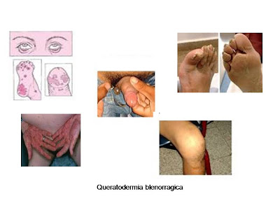 Queratodermia blenorragica
