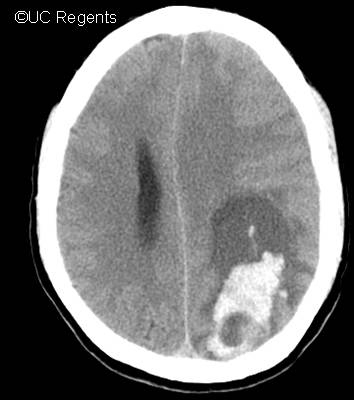 Ct+scan+of+brain+with+contrast