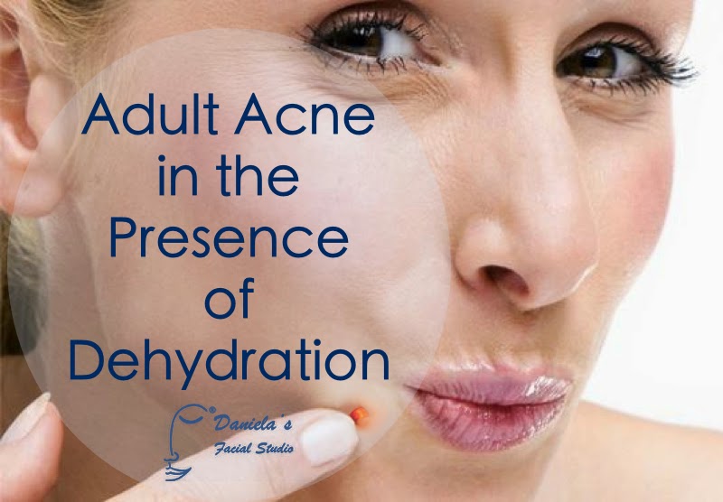 The Acne Whisperer Adult Acne in the Presence of Dehydration Part 2