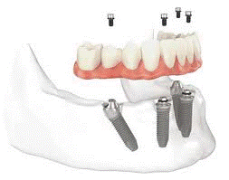 All on Four Implants All on Four Implants