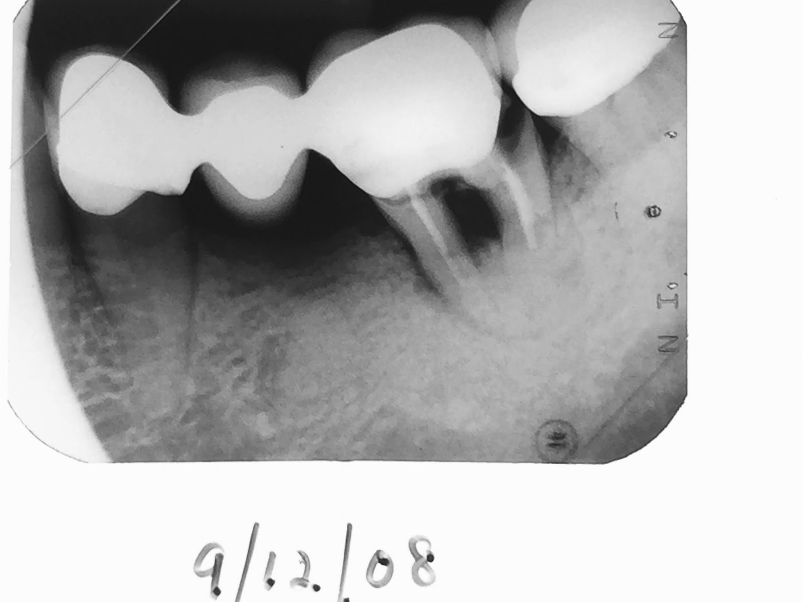 cantilever bridge dental
