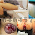 Obat Wasir Berdarah dan Bengkak Pada Anus thumbnail