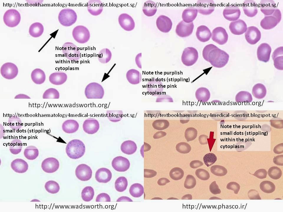 Haematology in a NutShell Basophilic Stippling