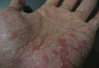 Dyshidrose La dyshidrose est une forme d' eczéma, dit eczéma bulleux, surtout présent sur les faces palmaires et/ou plantaires. Le nom provient du mot dyshidrotique, signifiant mauvaise sueur laquelle fut autrefois perçue comme la cause. Quelquefois elle est appelée Pompholyx (bulles en grec), terme généralement réservé pour les cas de vésicules pruritiques profondes.