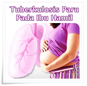 Pengobatan Herbal Tuberkulosis Paru Pada Ibu Hamil Pengobatan Herbal Tuberkulosis Paru Pada Ibu Hamil