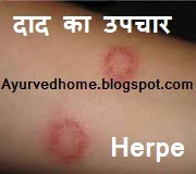 Herpes and Treatment at Home,  दाद का उपचार,  Daad Khaj Khujli