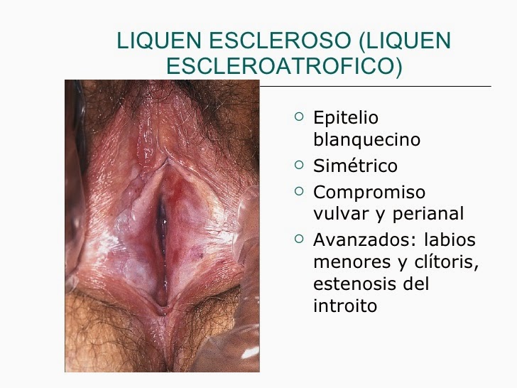 La crema para el tratamiento del acné con aliekspress las revocaciones