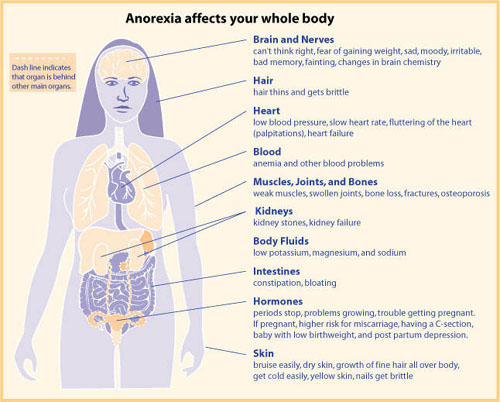 ما هو القهم العصابي (Anorexia nervosa)