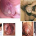 Kena Kencing Nanah, Harus Bagaimana Dok? thumbnail