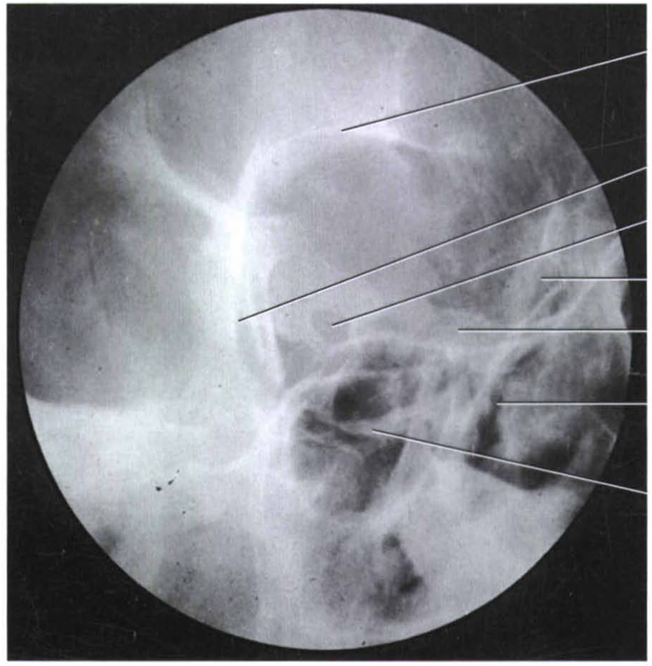 Gudang Medis teknik radiograf optic canal dan foramen