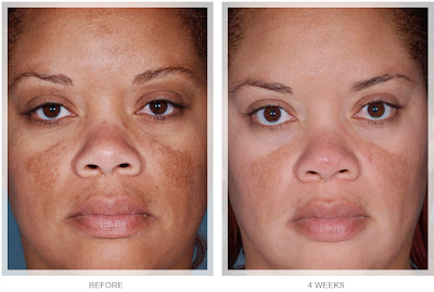 Vitamin C Serum For Face Before And After