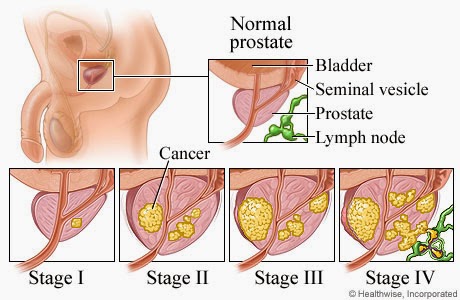Prostate Cancer 'May Be A Sexually Transmitted Disease'