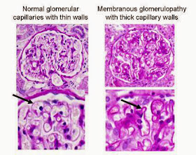 usmle comlex histology membranous glomerulonephritis renal pathology glomerular