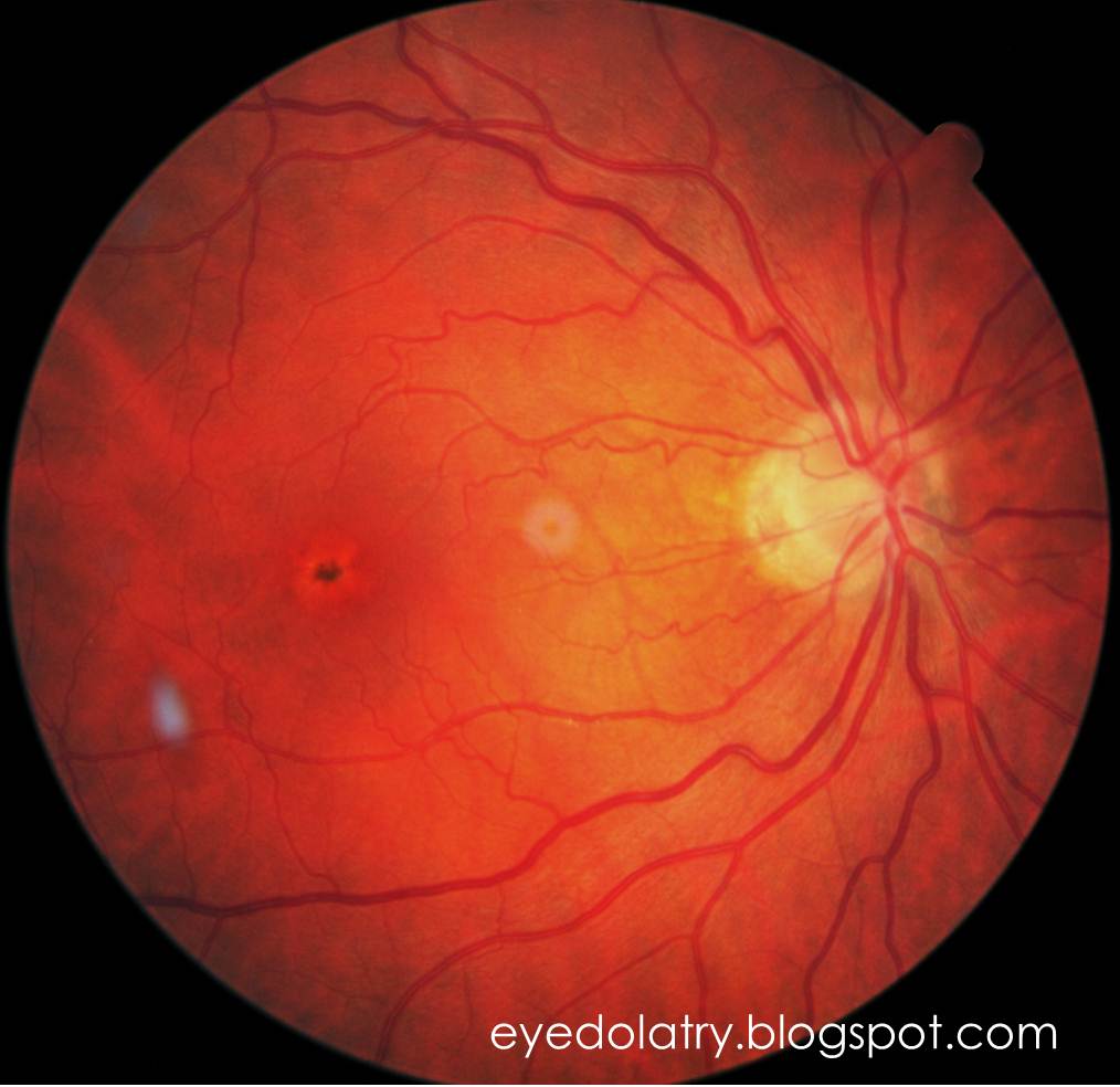 Retinal Photography Macula Eyedolatry