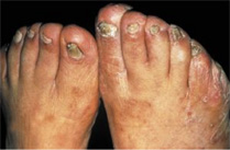 Que será si no curar el hongo sobre los dedos de los pies