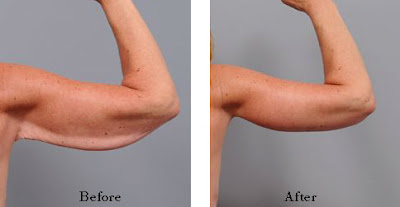 Mini Arm Lift Mini Arm Lift