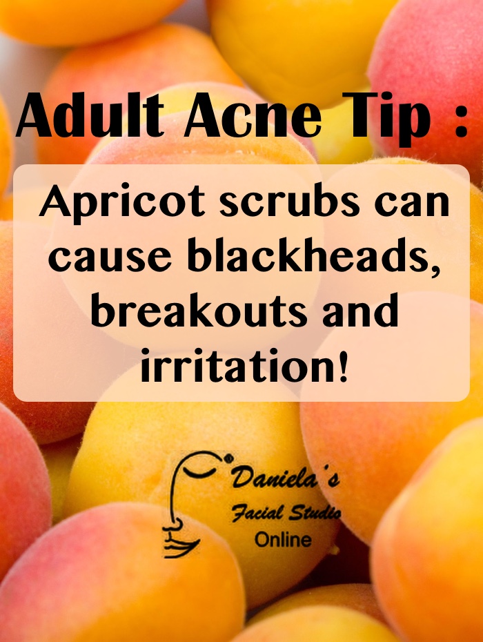 The Acne Whisperer All About Blackheads plus Tips for Adult Acne