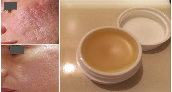 Unique Homemade Cream To Get Rid of Scars Completely Within 2 Weeks Unique Homemade Cream To Get Rid of Scars Completely Within 2 Weeks