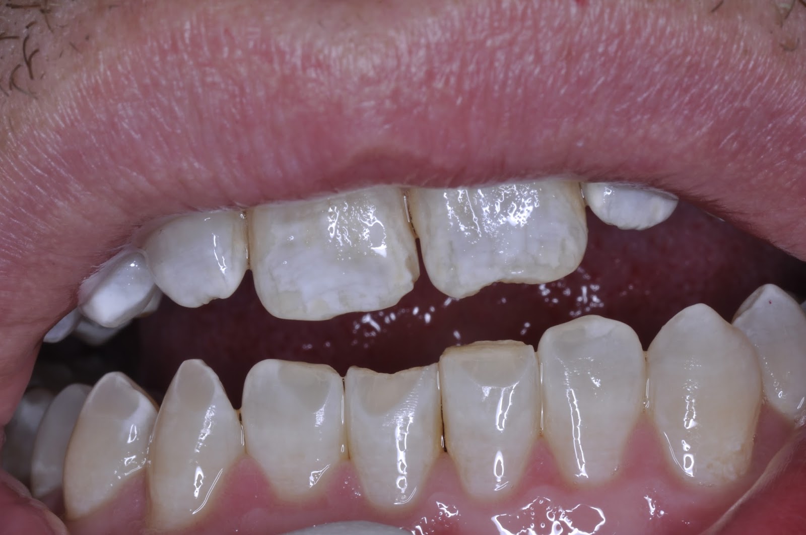 Why Do I Keep Grinding My Teeth At Night at Kena Davison blog