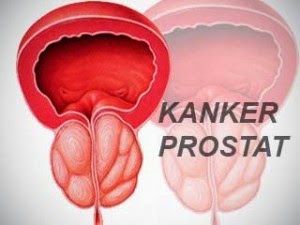pengobatan tumor Prostat, obat kanker prostat, pengobatan kanker prostat