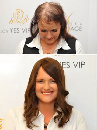 Hairblog Kahle Stellen Dunnes Haar Gehoren Der Vergangenheit An Microlines System Von Hairdreams