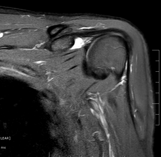 SubcoracoidSubscapularis Bursa MRI Sumer's Radiology Blog