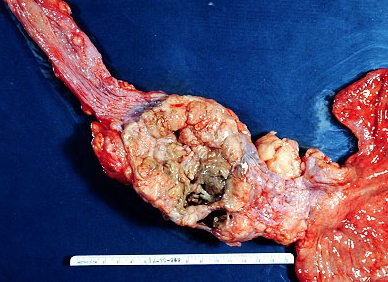 esophageal cancer principles and practice