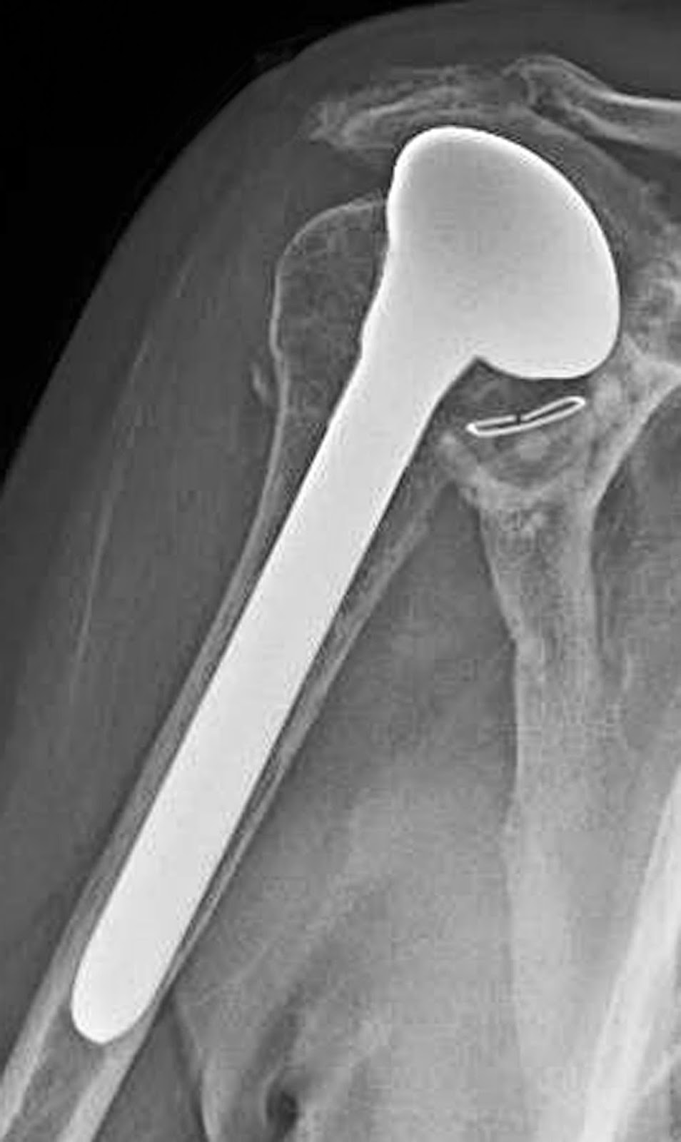 Shoulder Arthritis / Rotator Cuff Tears causes of shoulder pain