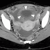 Tuberculous Peritonitis causes , clinical picture , investigations and treatment Tuberculous Peritonitis causes , clinical picture , investigations and treatment